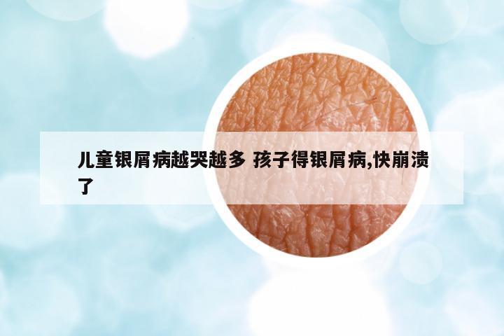 兒童銀屑病越哭越多 孩子得銀屑病,快崩潰了