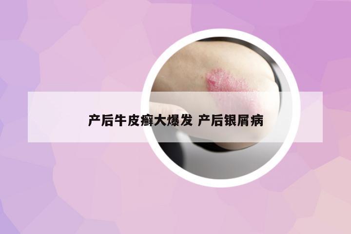 產(chǎn)后牛皮癬大爆發(fā) 產(chǎn)后銀屑病