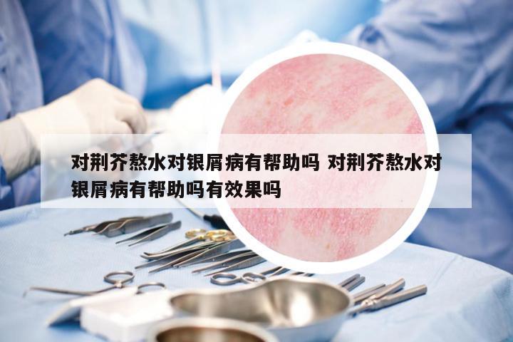 對荊芥熬水對銀屑病有幫助嗎 對荊芥熬水對銀屑病有幫助嗎有效果嗎