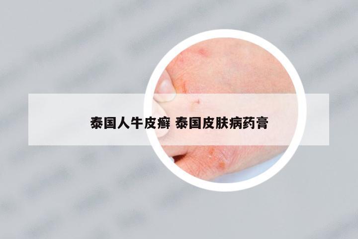 泰國(guó)人牛皮癬 泰國(guó)皮膚病藥膏