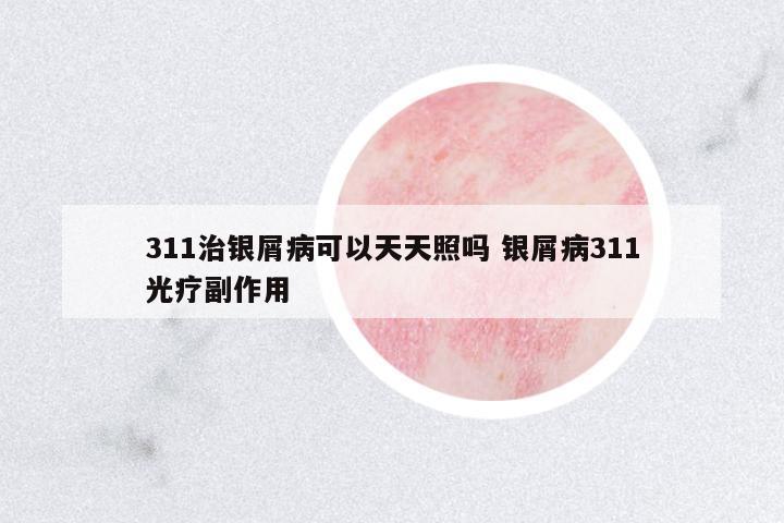 311治銀屑病可以天天照嗎 銀屑病311光療副作用