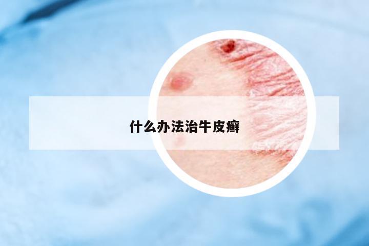 什么辦法治牛皮癬