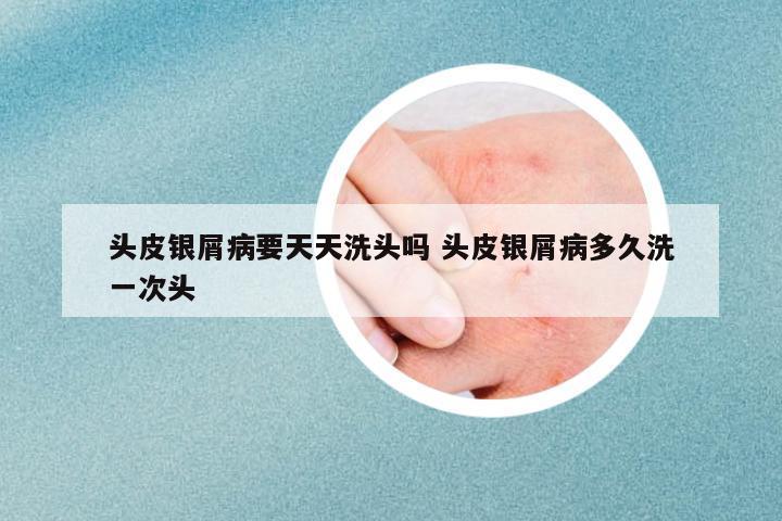 頭皮銀屑病要天天洗頭嗎 頭皮銀屑病多久洗一次頭
