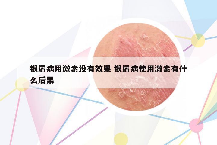 銀屑病用激素沒有效果 銀屑病使用激素有什么后果