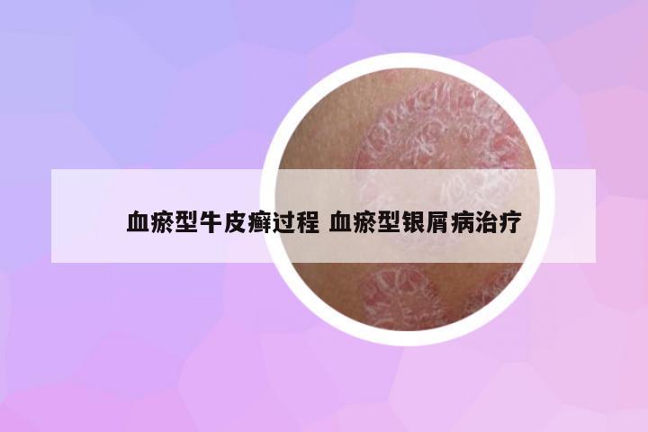 血瘀型牛皮癬過(guò)程 血瘀型銀屑病治療
