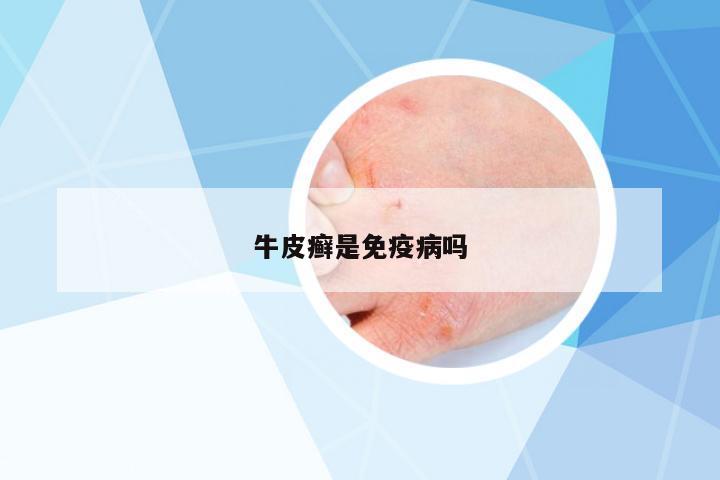 牛皮癬是免疫病嗎