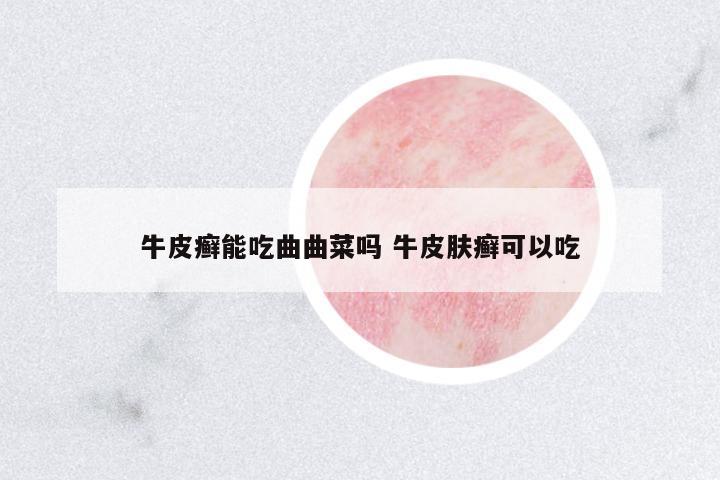 牛皮癬能吃曲曲菜嗎 牛皮膚癬可以吃