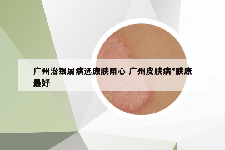 廣州治銀屑病選康膚用心 廣州皮膚病*膚康最好