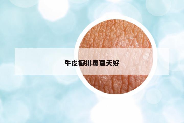 牛皮癬排毒夏天好