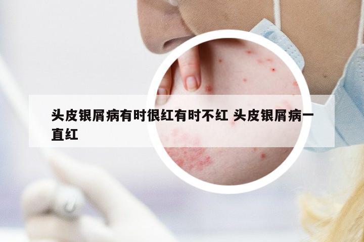 頭皮銀屑病有時(shí)很紅有時(shí)不紅 頭皮銀屑病一直紅