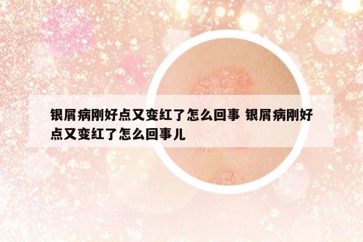 銀屑病剛好點(diǎn)又變紅了怎么回事 銀屑病剛好點(diǎn)又變紅了怎么回事兒