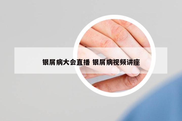 銀屑病大會直播 銀屑病視頻講座