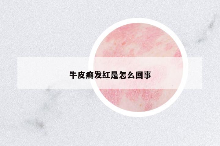 牛皮癬發(fā)紅是怎么回事