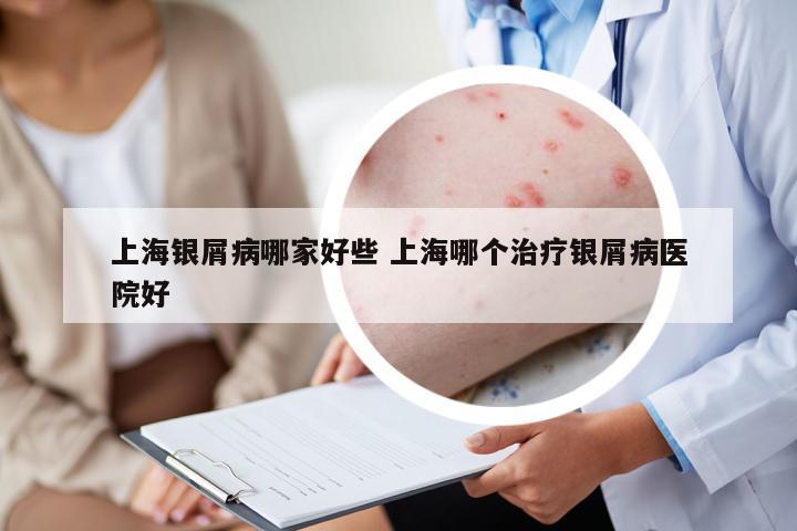 上海銀屑病哪家好些 上海哪個治療銀屑病醫(yī)院好