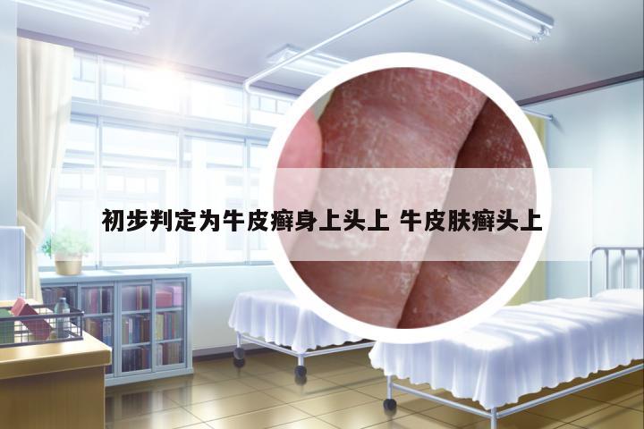 初步判定為牛皮癬身上頭上 牛皮膚癬頭上