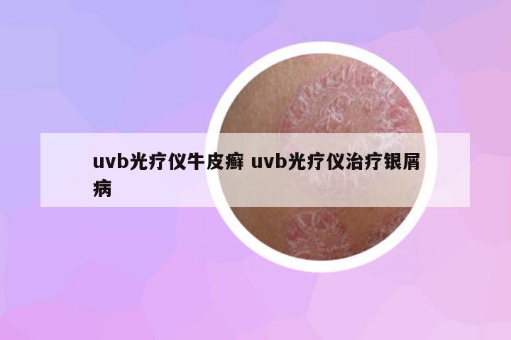 uvb光療儀牛皮癬 uvb光療儀治療銀屑病