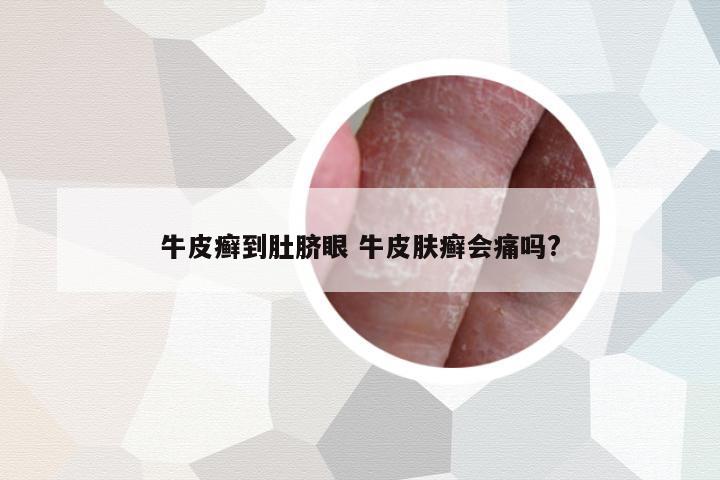牛皮癬到肚臍眼 牛皮膚癬會痛嗎?