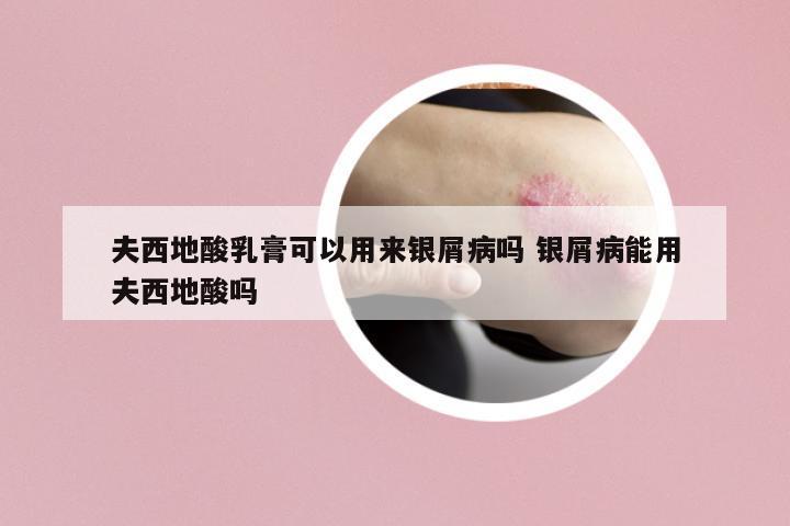 夫西地酸乳膏可以用來銀屑病嗎 銀屑病能用夫西地酸嗎