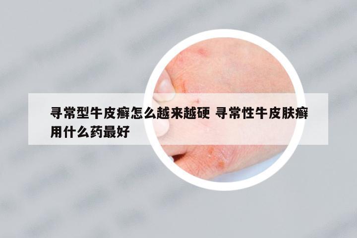 尋常型牛皮癬怎么越來越硬 尋常性牛皮膚癬用什么藥最好