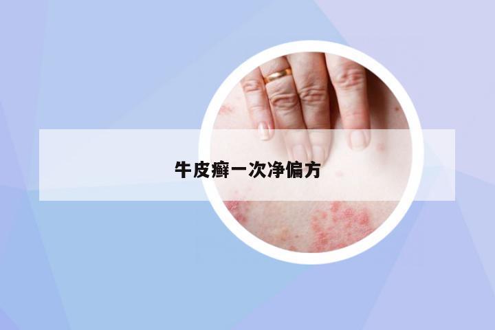 牛皮癬一次凈偏方