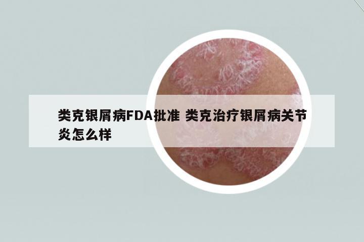類(lèi)克銀屑病FDA批準(zhǔn) 類(lèi)克治療銀屑病關(guān)節(jié)炎怎么樣