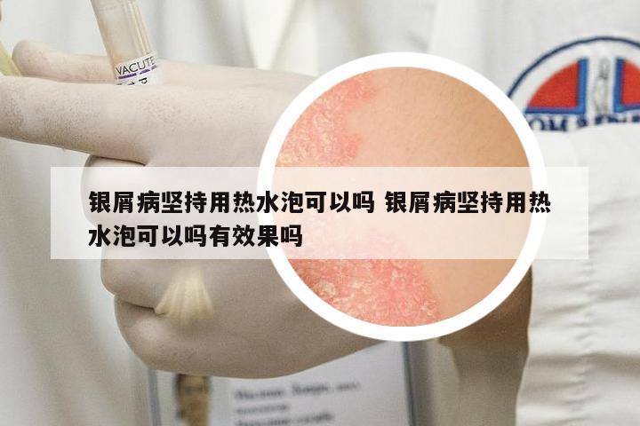 銀屑病堅持用熱水泡可以嗎 銀屑病堅持用熱水泡可以嗎有效果嗎