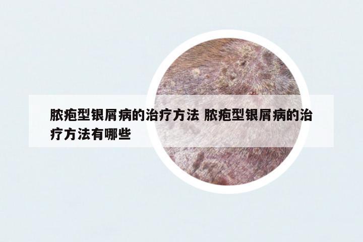 膿皰型銀屑病的治療方法 膿皰型銀屑病的治療方法有哪些