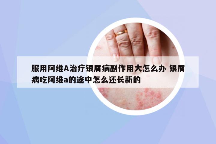 服用阿維A治療銀屑病副作用大怎么辦 銀屑病吃阿維a的途中怎么還長(zhǎng)新的