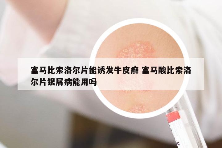富馬比索洛爾片能誘發(fā)牛皮癬 富馬酸比索洛爾片銀屑病能用嗎