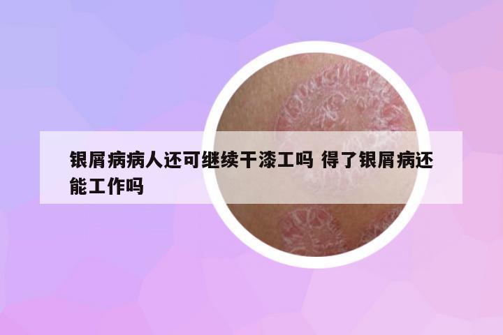 銀屑病病人還可繼續(xù)干漆工嗎 得了銀屑病還能工作嗎