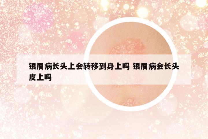 銀屑病長頭上會(huì)轉(zhuǎn)移到身上嗎 銀屑病會(huì)長頭皮上嗎