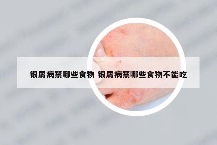 銀屑病禁哪些食物 銀屑病禁哪些食物不能吃