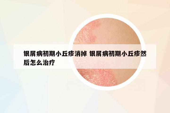 銀屑病初期小丘疹消掉 銀屑病初期小丘疹然后怎么治療