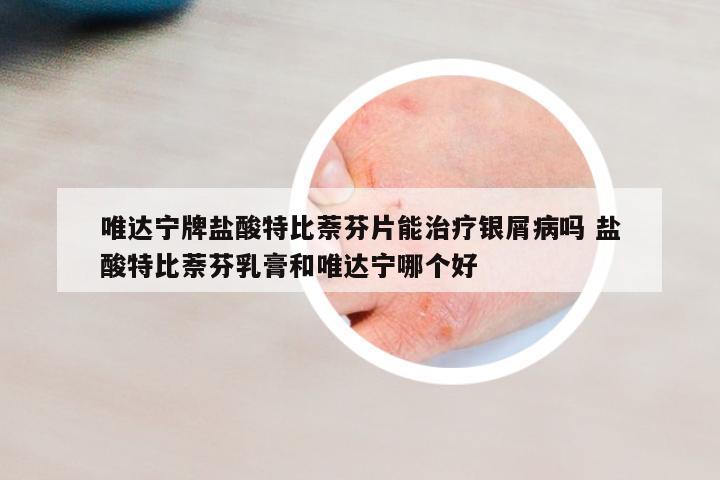 唯達(dá)寧牌鹽酸特比萘芬片能治療銀屑病嗎 鹽酸特比萘芬乳膏和唯達(dá)寧哪個(gè)好