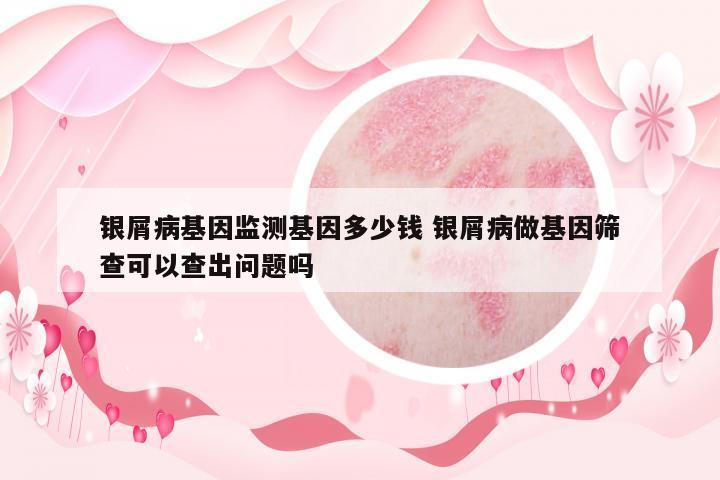 銀屑病基因監(jiān)測基因多少錢 銀屑病做基因篩查可以查出問題嗎