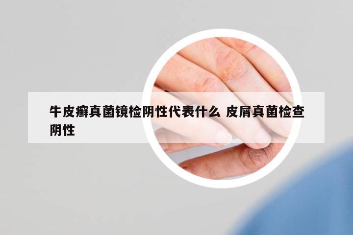牛皮癬真菌鏡檢陰性代表什么 皮屑真菌檢查陰性