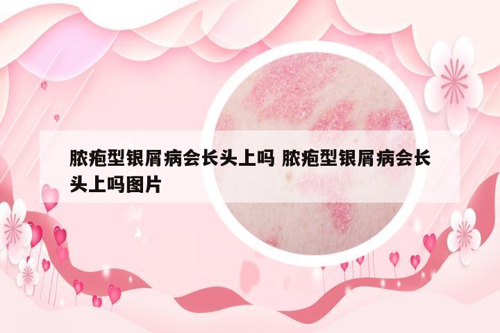 膿皰型銀屑病會長頭上嗎 膿皰型銀屑病會長頭上嗎圖片