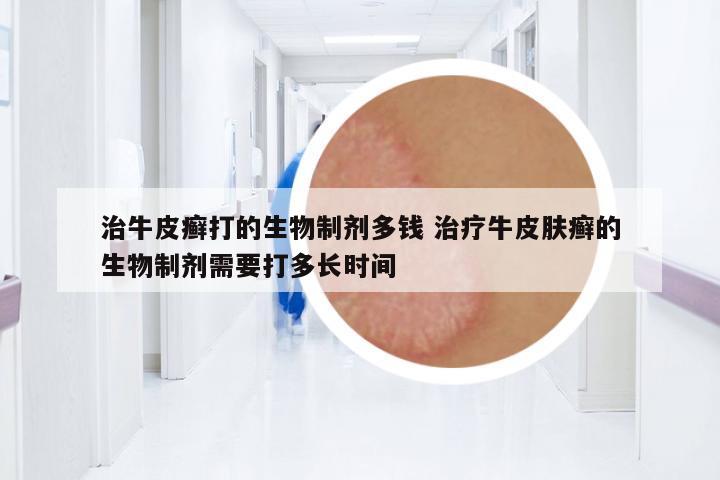 治牛皮癬打的生物制劑多錢(qián) 治療牛皮膚癬的生物制劑需要打多長(zhǎng)時(shí)間