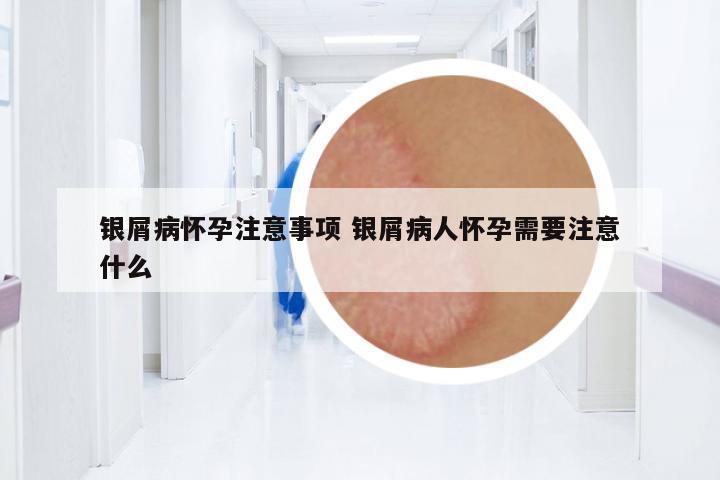銀屑病懷孕注意事項 銀屑病人懷孕需要注意什么