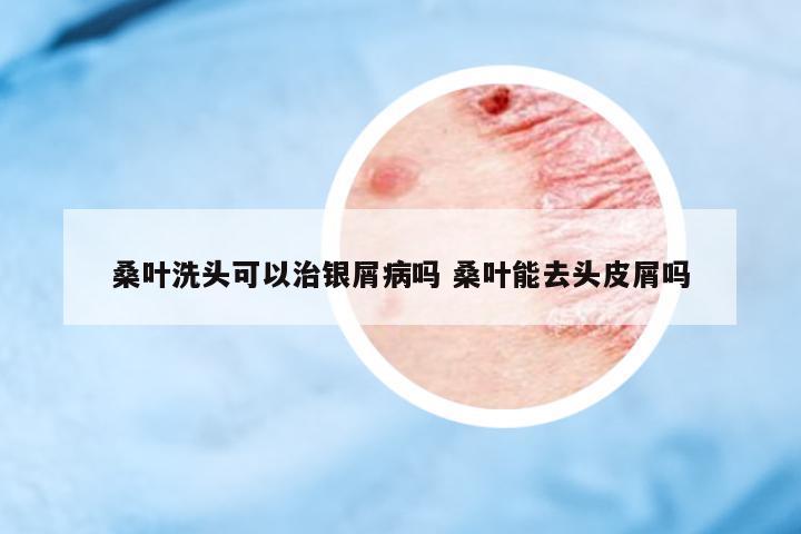 桑葉洗頭可以治銀屑病嗎 桑葉能去頭皮屑嗎