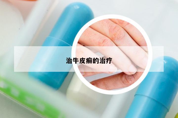 治牛皮癬的治療