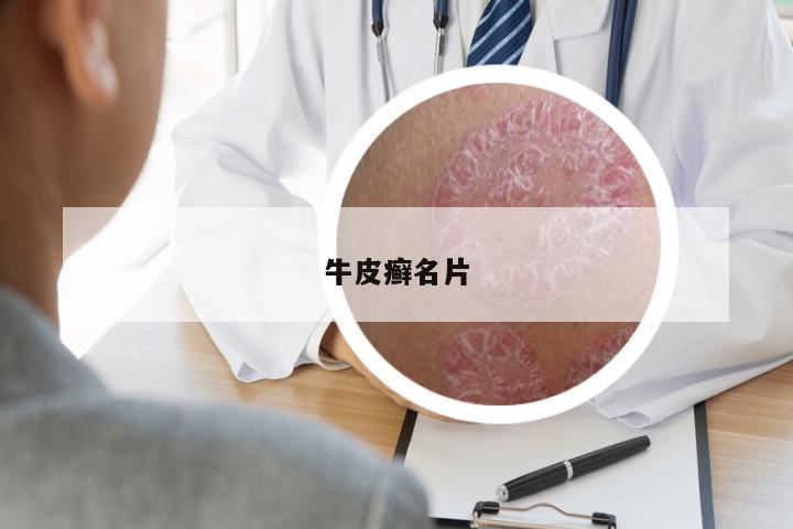 牛皮癬名片