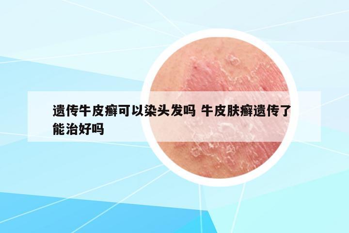 遺傳牛皮癬可以染頭發(fā)嗎 牛皮膚癬遺傳了 能治好嗎
