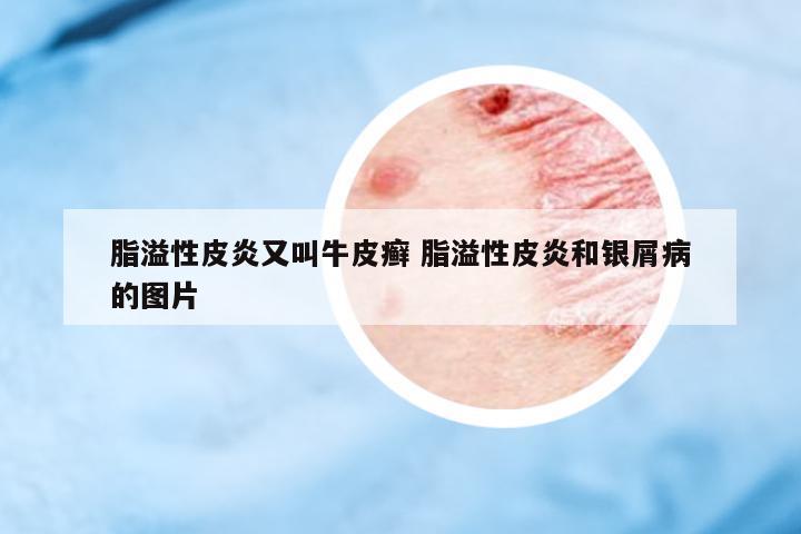 脂溢性皮炎又叫牛皮癬 脂溢性皮炎和銀屑病的圖片