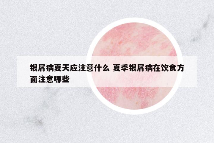 銀屑病夏天應(yīng)注意什么 夏季銀屑病在飲食方面注意哪些