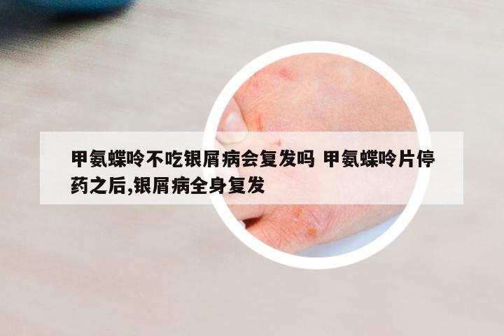 甲氨蝶呤不吃銀屑病會(huì)復(fù)發(fā)嗎 甲氨蝶呤片停藥之后,銀屑病全身復(fù)發(fā)