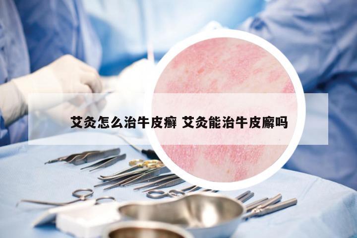 艾灸怎么治牛皮癬 艾灸能治牛皮廨嗎