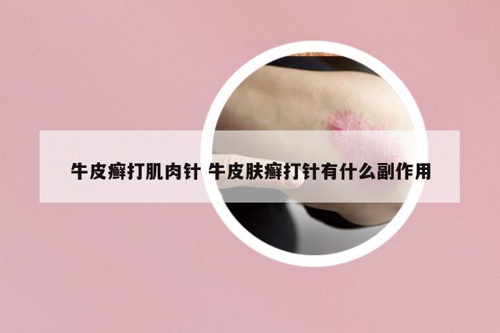 牛皮癬打肌肉針 牛皮膚癬打針有什么副作用