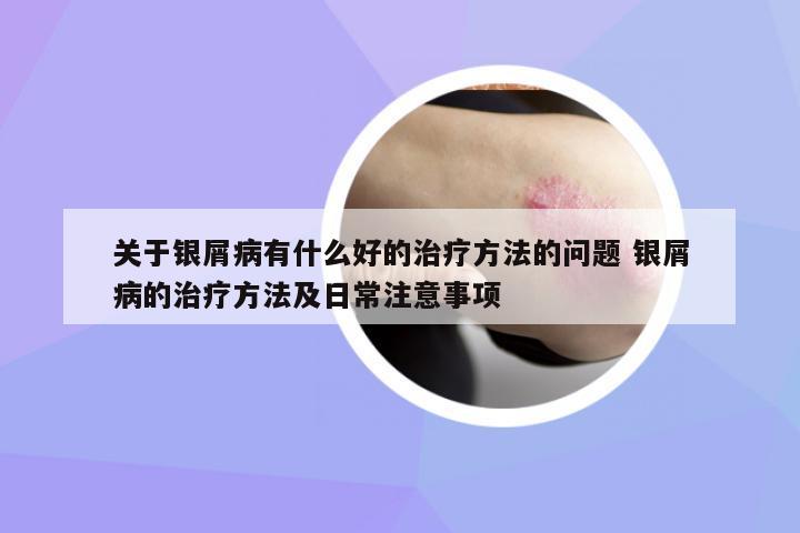 關(guān)于銀屑病有什么好的治療方法的問(wèn)題 銀屑病的治療方法及日常注意事項(xiàng)