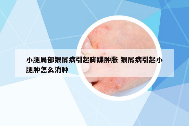 小腿局部銀屑病引起腳踝腫脹 銀屑病引起小腿腫怎么消腫